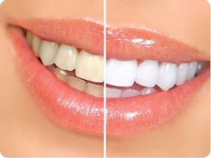 Îngrijire dentară cermet (dinți) Îngrijirea dentară din metaloceramice
