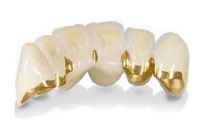 Îngrijire dentară cermet (îngrijire) Îngrijirea dentară din metaloceramice