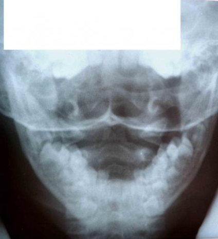 procesul de odontoid al doilea vertebră cervicală - medicină legală din fr