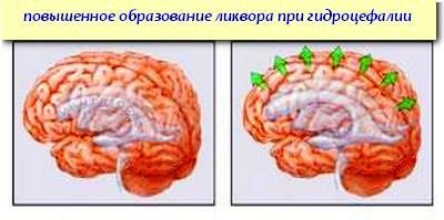 Хипертонична (hydrocephalic) синдром при възрастни и новородени