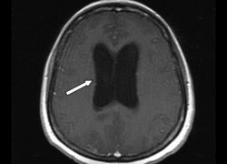 Хипертонична (hydrocephalic) синдром при възрастни и новородени