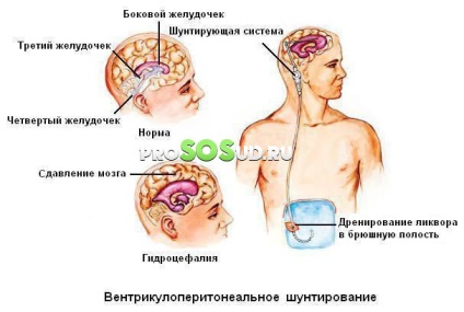 Хипертонична (hydrocephalic) синдром при възрастни и новородени