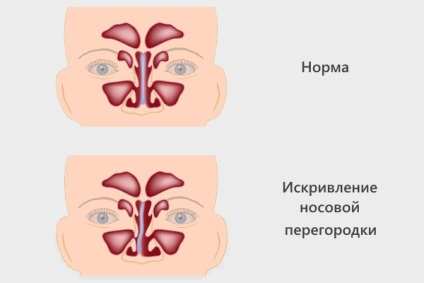 Катарален синузит симптоми, лечение и диагностика