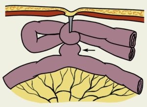 simptome obstrucție intestinală