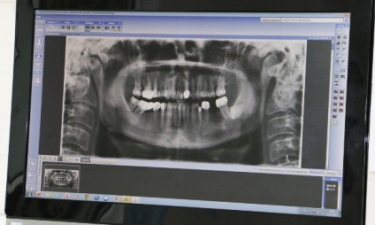 Панорамна изстрел (ortopantomogramma) зъби цена показания, предимства