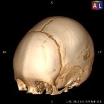 Trigonocephaly (radioulnara metopic) neyrodeti