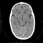 Trigonocephaly (radioulnara metopic) neyrodeti