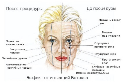 11 Întrebări și răspunsuri cu privire la Botox-ul, centrul de mase plastice piept - Dikov Yu (trebuie să consulte un chirurg) 11 Întrebări și răspunsuri cu privire la Botox, san plastic Center - st Dikov