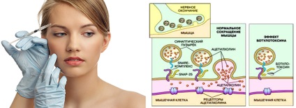 11 Întrebări și răspunsuri cu privire la Botox, Centrul de plastic de san - st Dickov (Botox) 11 Întrebări și răspunsuri cu privire la Botox, san plastic Center - st Dikov