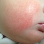 Dermatita atopica la sugari de prim ajutor, tratament și simptome (de ajutor) Dermatita atopica la sugari de prim ajutor, tratament și simptome