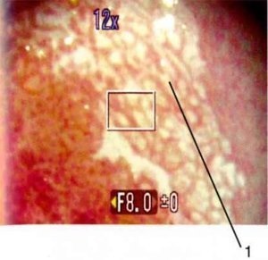 Imaginea colposcopic anormală (imagine vascularizării patologică) Imaginea colposcopic anormală