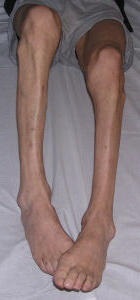 Atrofia musculară (atrofie musculară se dezvoltă) atrofie musculară