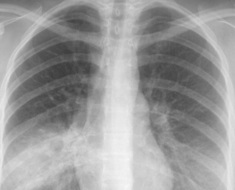 BCG ca o vindecare (vindecare) BCG ca o vindecare