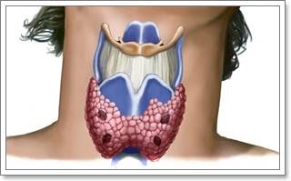 Eutiroidiene boli tiroidiene, hipotiroidism, hipertiroidism - simptome si tratament (glanda) Eutiroidiene boli tiroidiene, hipotiroidism, hipertiroidism - simptome si tratament
