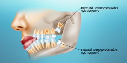 Sore înțelepciunea dinte dureri gingiile de ce și cum pentru a calma durerea (gingii) Sore înțelepciunea dinte dureri gingiile de ce și cum pentru a calma durerea