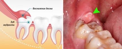 dinte înțelepciune Sore gume dureri de ce și cum pentru a calma durerea (durere) Sore înțelepciunea dinte dureri gingiile de ce și cum pentru a calma durerea