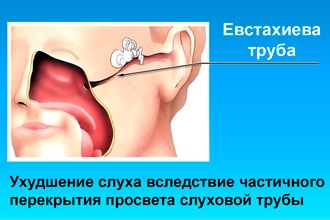 Ce este rinita hiperplazice - simptome și tratament (tratament) Ce este rinita hiperplazice - simptome și tratament