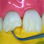 Revista dentara (a dintilor anteriori) revista Dental