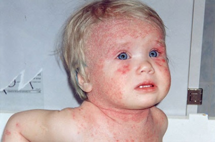Dermatita la copii fotografie cauze de tratament pentru sugari, simptomele (cauzele dermatitei de tratament pentru copii unguent) Dermatita la copii fotografie cauze de tratament pentru sugari, simptome