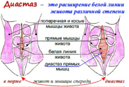 Simptomele diastasis postpartum și tratament (peretelui abdominal anterior) Diastazei după naștere și simptome de tratament