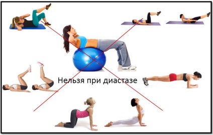 Simptomele diastasis postpartum și tratament (peretelui abdominal anterior) Diastazei după naștere și simptome de tratament