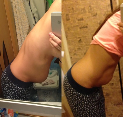 Simptomele diastasis postpartum și tratament (abdominis) rectus Diastazei după naștere și simptome de tratament