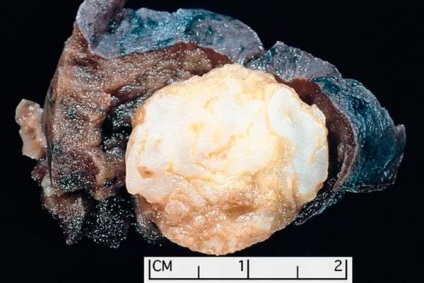 Benign descrierea pulmonare tumorale si tratate (tumoră benignă a simptomelor pulmonare) Benign descrierea pulmonare tumorale si tratament
