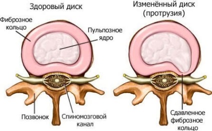 proeminența dorsale determină disc, simptome, tratament, chirurgie