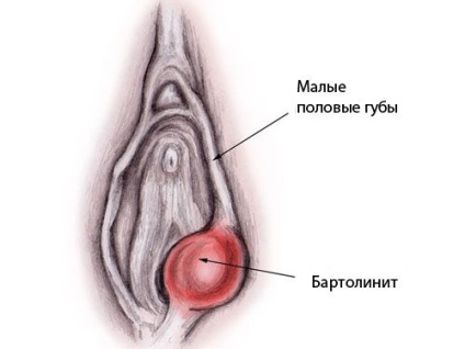Cu două coarne uter, șa, cu cauze de partiție, diagnostic și metroplasty (uter) uter două coarne, șa, cu cauze de partiție, diagnostic și metroplasty