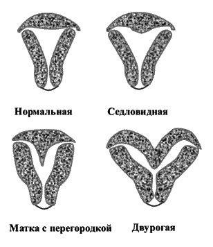 Cu două coarne uter, șa, cu cauze de partiție, diagnostic și metroplasty (uter) uter două coarne, șa, cu cauze de partiție, diagnostic și metroplasty