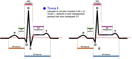 E-cardio st elevație (elevație) a segmentului E-cardio-supradenivelare de segment st