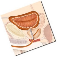 utiliza în mod eficient ASD fracțiunea 2 prostatita la bărbați (cerere) utiliza în mod eficient ASD fracțiunea 2 prostatita la bărbați