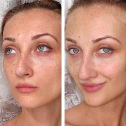 Comentarii Emolium cremă (instrucțiuni de utilizare) (cremă obișnuită Emolium) Recenzii Emolium crema (Instrucțiuni de utilizare)