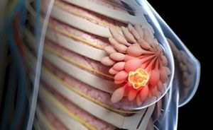 Fibroadenoma sânilor - cauze și tratament (tratament) Sânilor fibroadenom - cauze si tratament