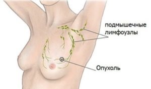 Fibroadenoma Breast - cauze si tratament (prostata) Sânilor fibroadenom - cauze si tratament