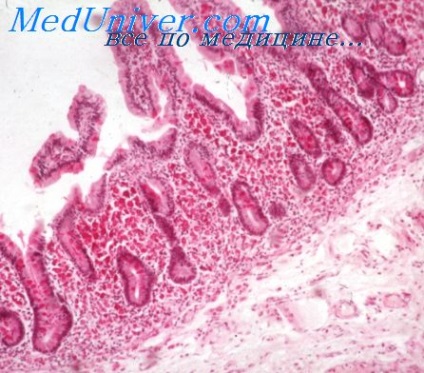 anemie hemolitică (clinica anemia hemolitică) anemie hemolitică