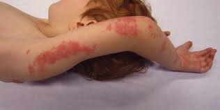 Cauze de tratament pentru copii Herpes de corp (corp) copii Herpes tratamente corporale, cauze