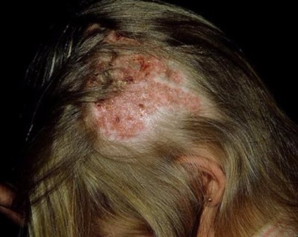 ciuperca pielii capului fotografie, simptome și tratament