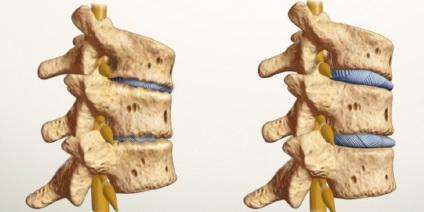 SHmorlja hernie lombare, a coloanei vertebrale toracice, ceea ce este, de tratament (a) SHmorlja hernie lombare, a coloanei vertebrale toracice, ceea ce este, un tratament
