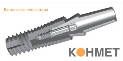 Implanturile Conmet (CONMET) beneficii, instalare, preț real (implanturi Conmet site-ul oficial) Implanturile CONMET (CONMET) beneficii, instalare, comentarii, pret