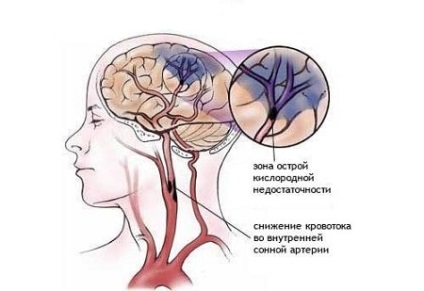 Cerebral ischemic prognosticului accident vascular cerebral, consecințele tratamentului (prognosticul) Ischemica prognosticul atacului cerebral, consecințele tratamentului