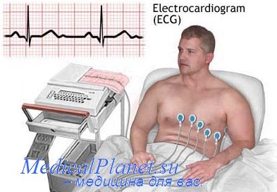 Antecedente de infarct miocardic (angină pectorală) Antecedente de infarct miocardic