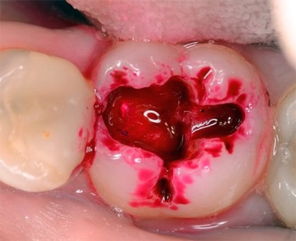 Cum să utilizați un marker al cariilor (cariilor dentare cumpăra LED-uri) Cum să utilizați marcator cariilor dentare