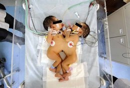 Ca gemeni siamezi separate (numai unul din patru) Cum de a împărtăși gemenii siamezi