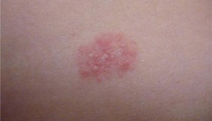 Ce este dermatita la copii (foto) (arata) Ce este dermatita la copii (foto)