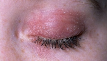Ce este dermatita la copii (foto) (arata) Ce este dermatita la copii (foto)