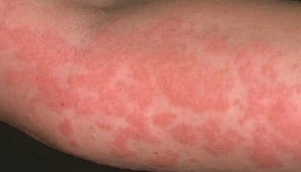Ce este dermatita la copii (foto) (arata) Ce este dermatita la copii (foto)
