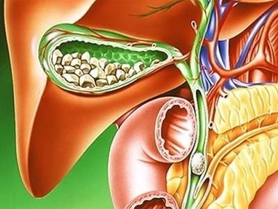 colecistită calculoasa și tratamentul său de remedii populare