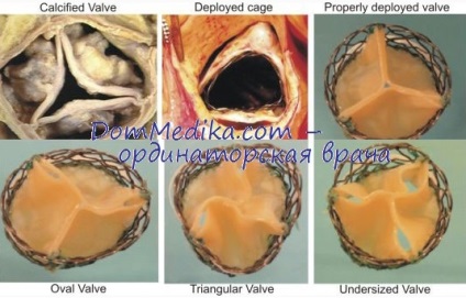 Calcificarea valvelor cardiace (diagnostic de calcifiere a valvelor inimii) Calcificarea valvelor cardiace