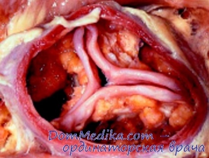 Calcificarea valvelor cardiace (tratamentul calcifiere a valvelor inimii) Calcificarea valvelor cardiace
